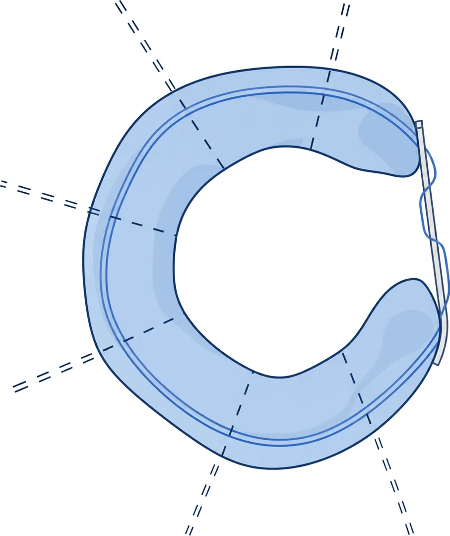Plan-view illustration of the LunaFlex Meniscus with four numbered markers identifying the composite body, suture threads, circumferential reinforcement and fixation bridge.